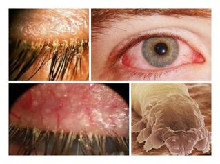 gejala adanya parasit di bawah kulit manusia